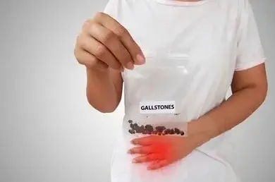 gallstone